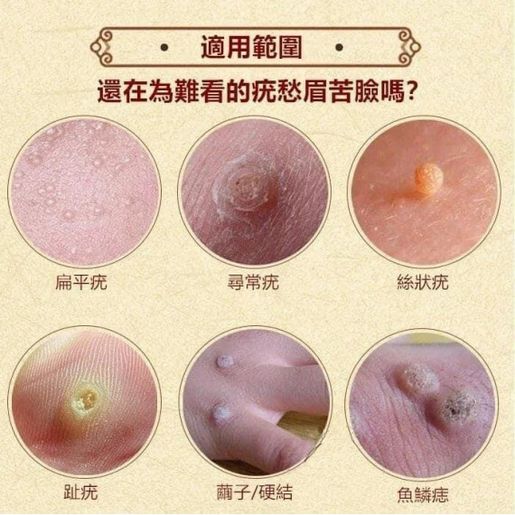 Bacitracin-Fradiomycin Sulfate Baramycin Ointment 10g(No Box)扁平疣軟膏