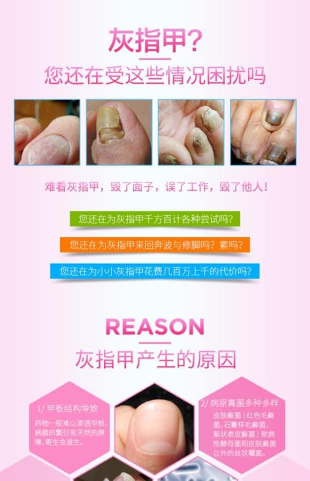 Zefnart Onychomycosis Beriberi Antifungal Lotion 10ml灰指甲腳氣抗真菌藥水